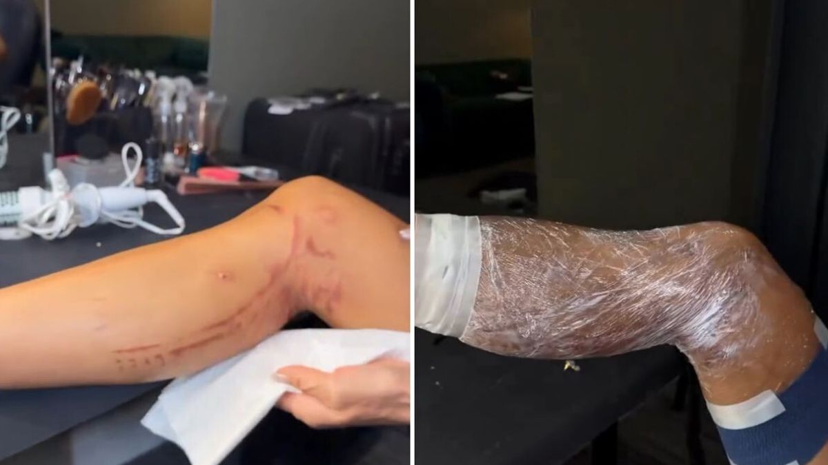 La gamba ustionata di Nicole Scherzinger