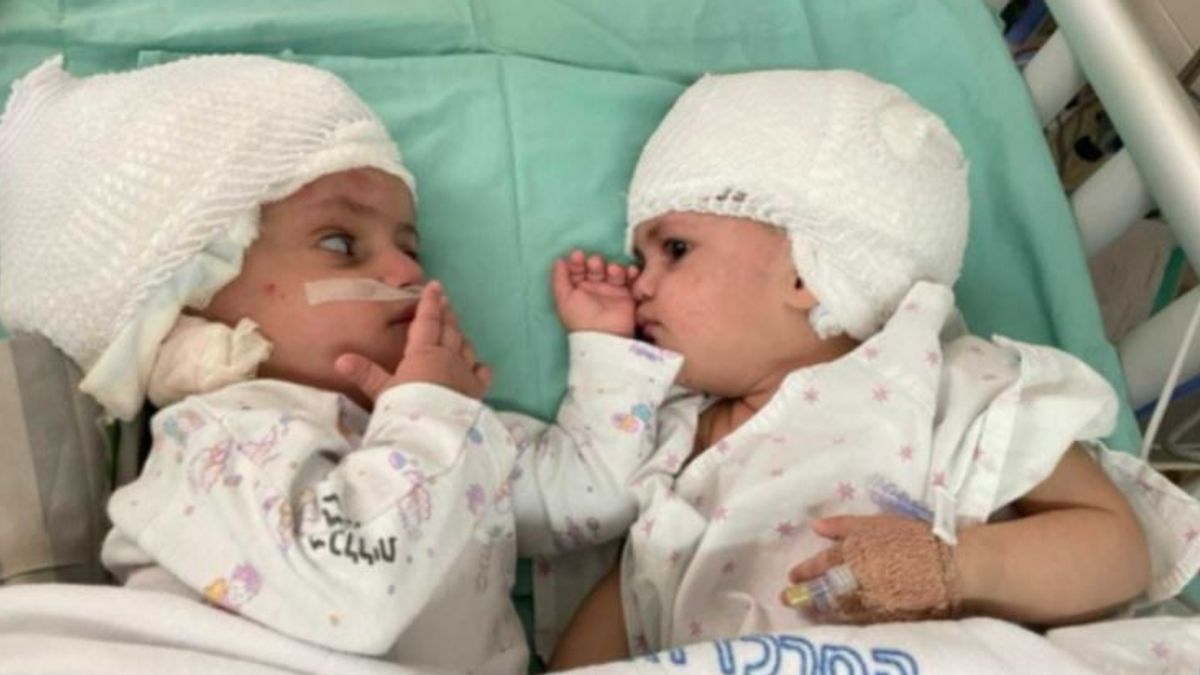 Le gemelline siamesi separate con successo al Soroka Medical Center nella città di Beersheba, in Israele