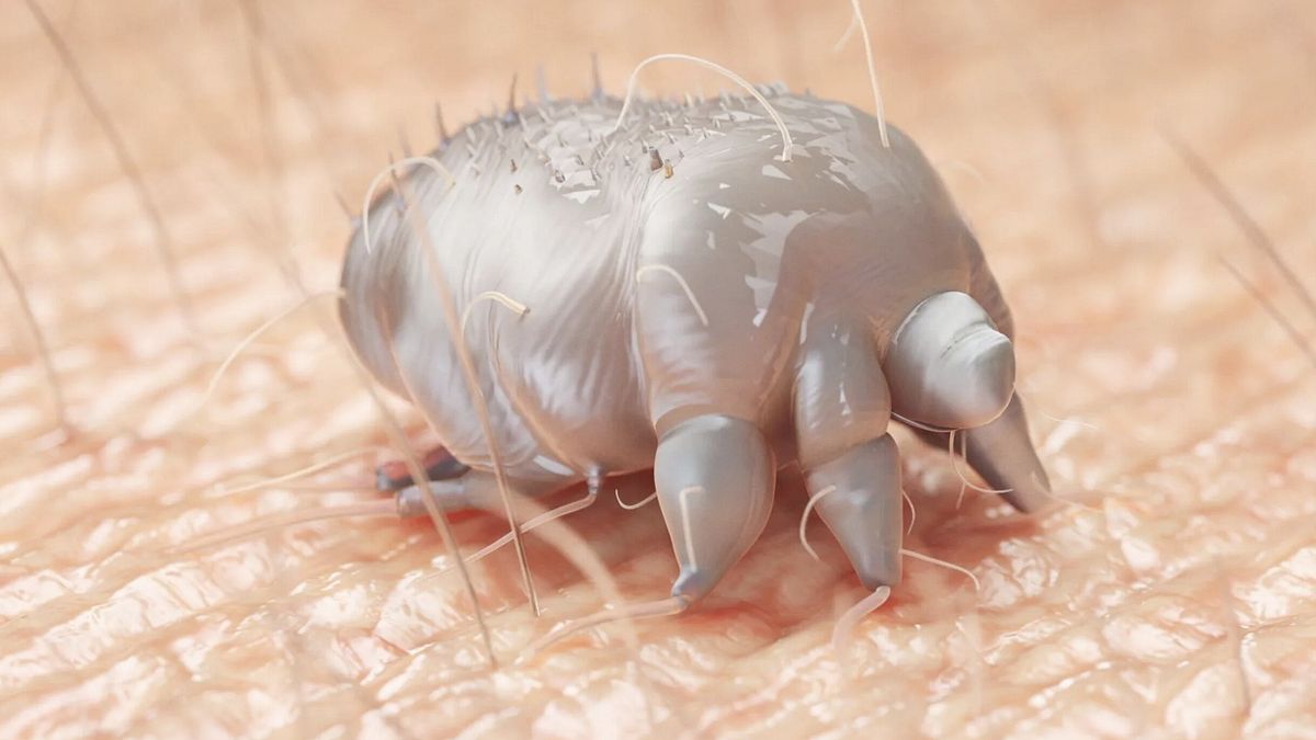 L'acaro della scabbia (Sarcoptes scabiei) è la causa della malattia