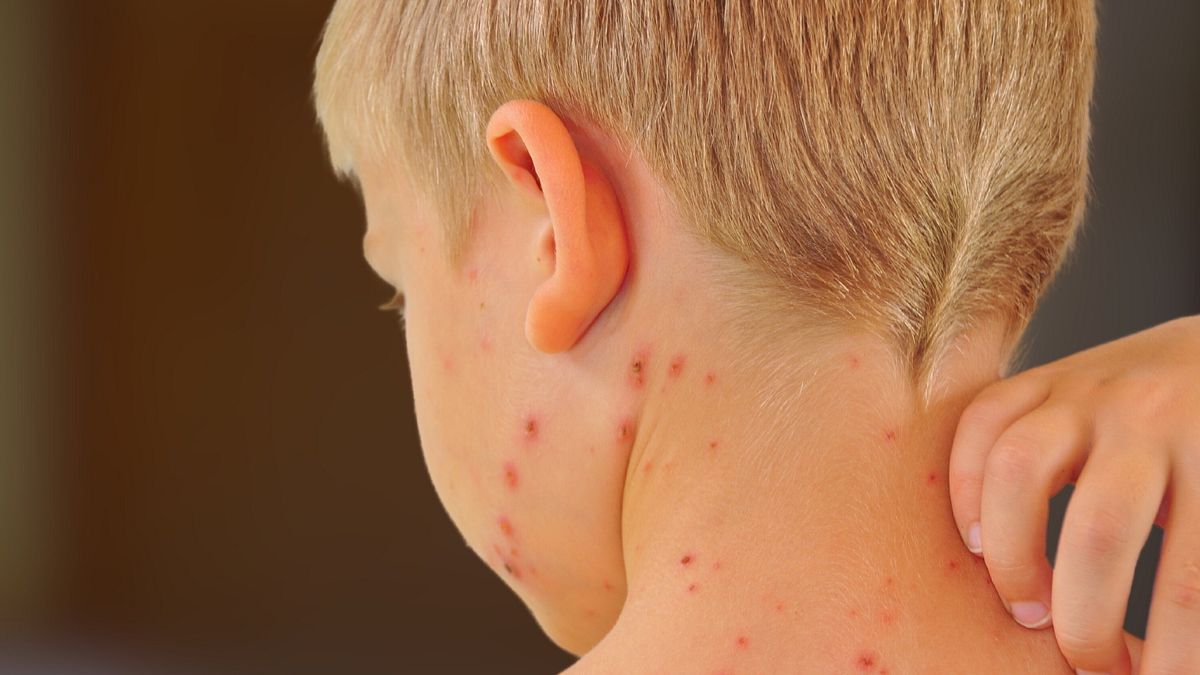 Morbillo, boom di casi negli Stati Uniti: mai così tanti dal 1992