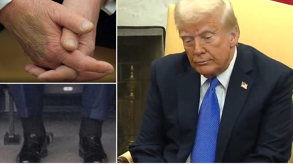 Usa, Casa Bianca: "Trump ha un'insufficienza venosa cronica"