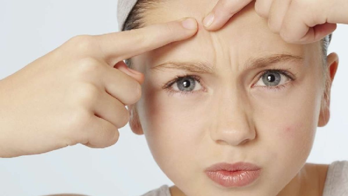 Altro che cioccolato, la causa dell'acne potrebbe essere un eccesso di