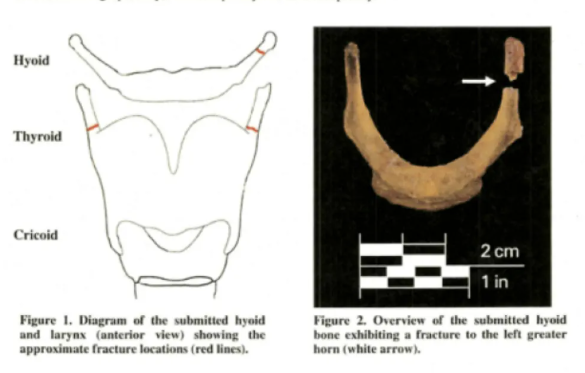 © Dal Web  | Jeffrey Epstein sul lettino del carcere durante le operazioni di rianimazione