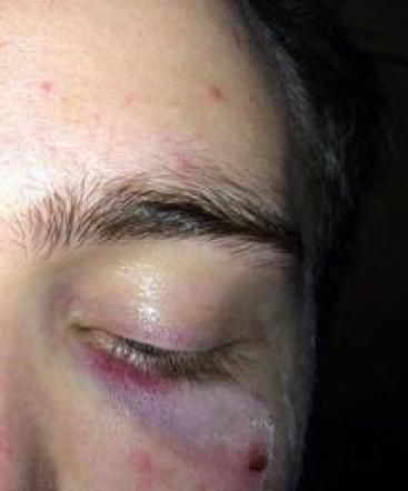 © ansa  | Un particolare del volto tumefatto di Stefano, il 21enne aggredito su un autobus a Torino perché gay