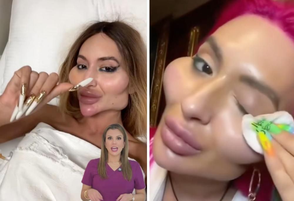 Le foto senza filler della donna con le guance più grandi al mondo