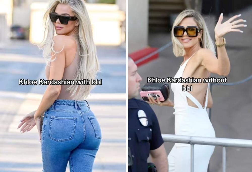 “BBL smell”: cos’è l’odore post Brazilian Butt Lift e perché compare