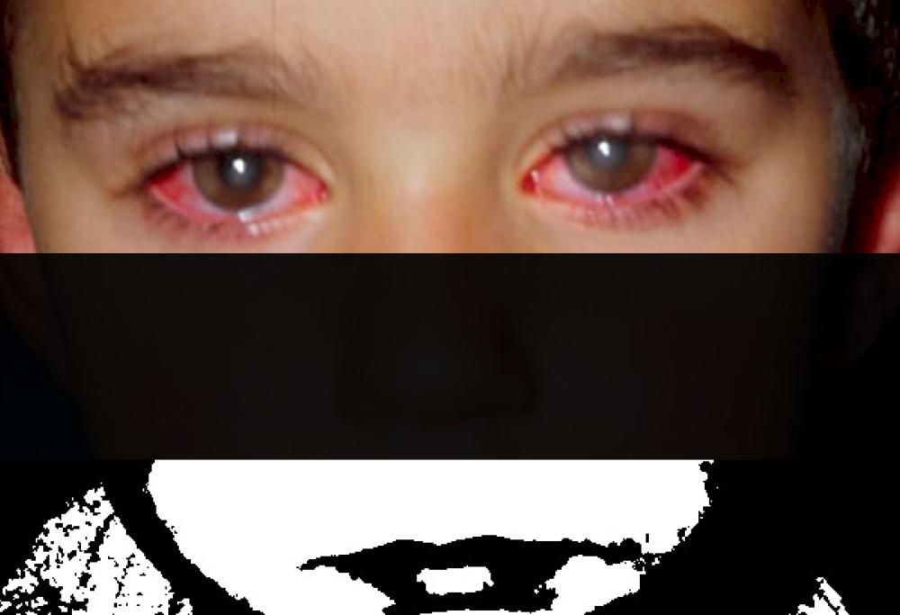 Un bambino ha perso il 25% della sua vista a causa di un giocattolo