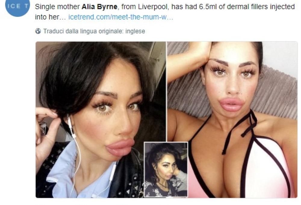 Chirurgia, ecco la mamma che ha scelto di rifarsi delle labbra enormi