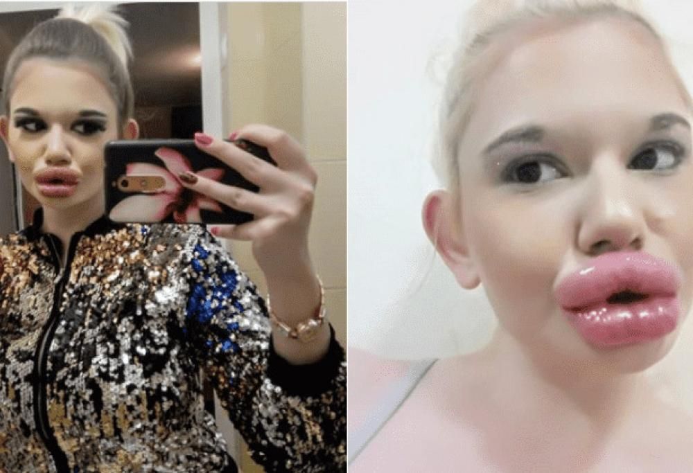 La Barbie reale che vuole le labbra più grandi al mondo ha ottenuto la sua ventesima iniezione