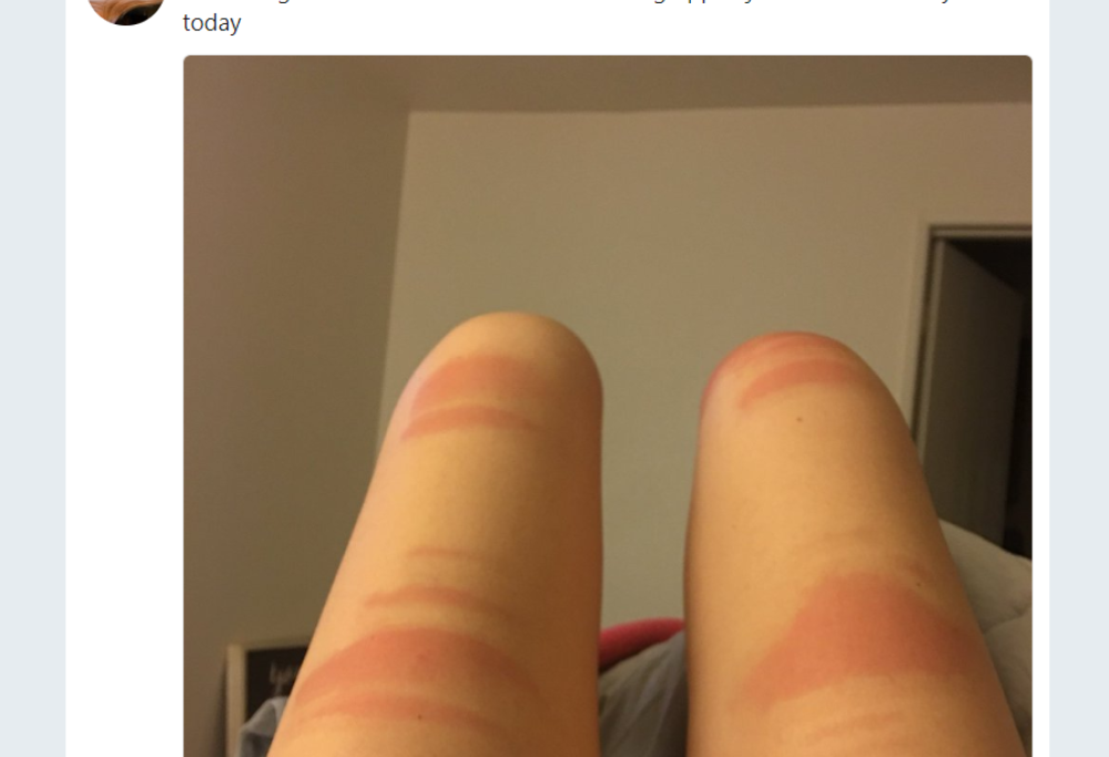 Ecco perché non si deve mai prendere il sole con addosso dei jeans strappati