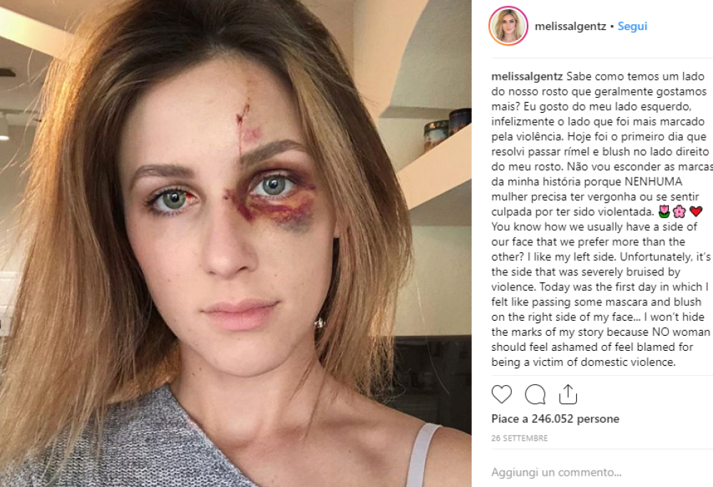 Picchiata dal fidanzato per una foto su Instagram, lei pubblica la foto del massacro