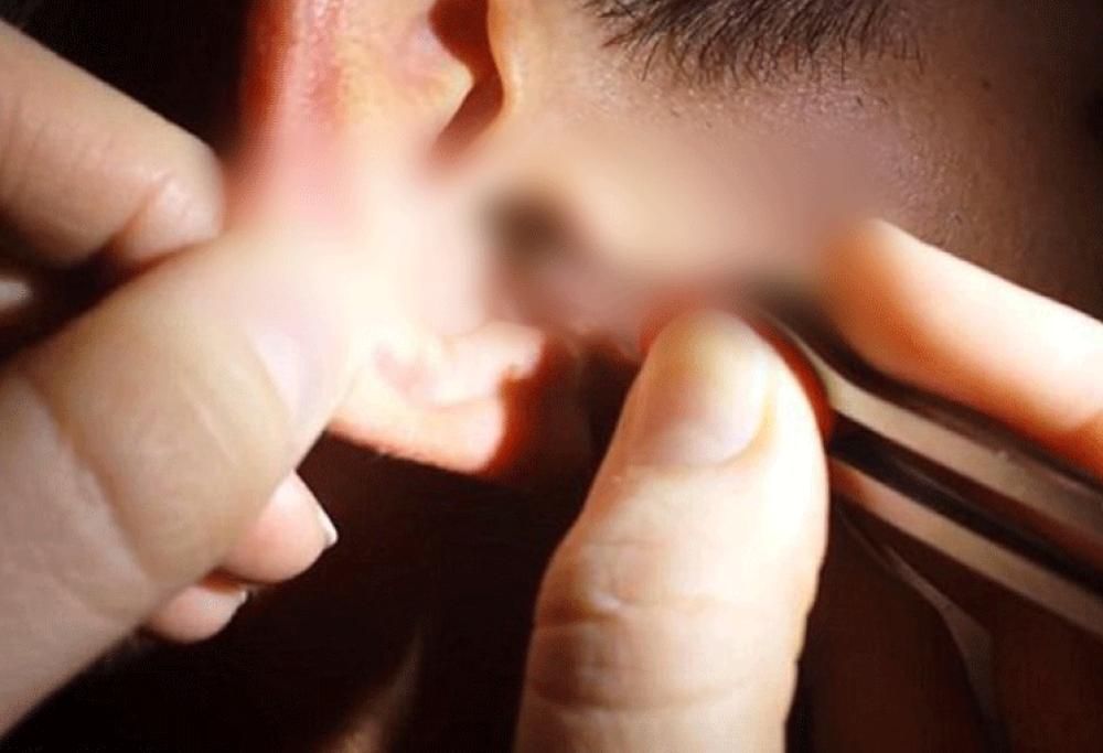 Cerume da Guinness World Record! (immagini forti, sconsigliato a chi è debole di stomaco)