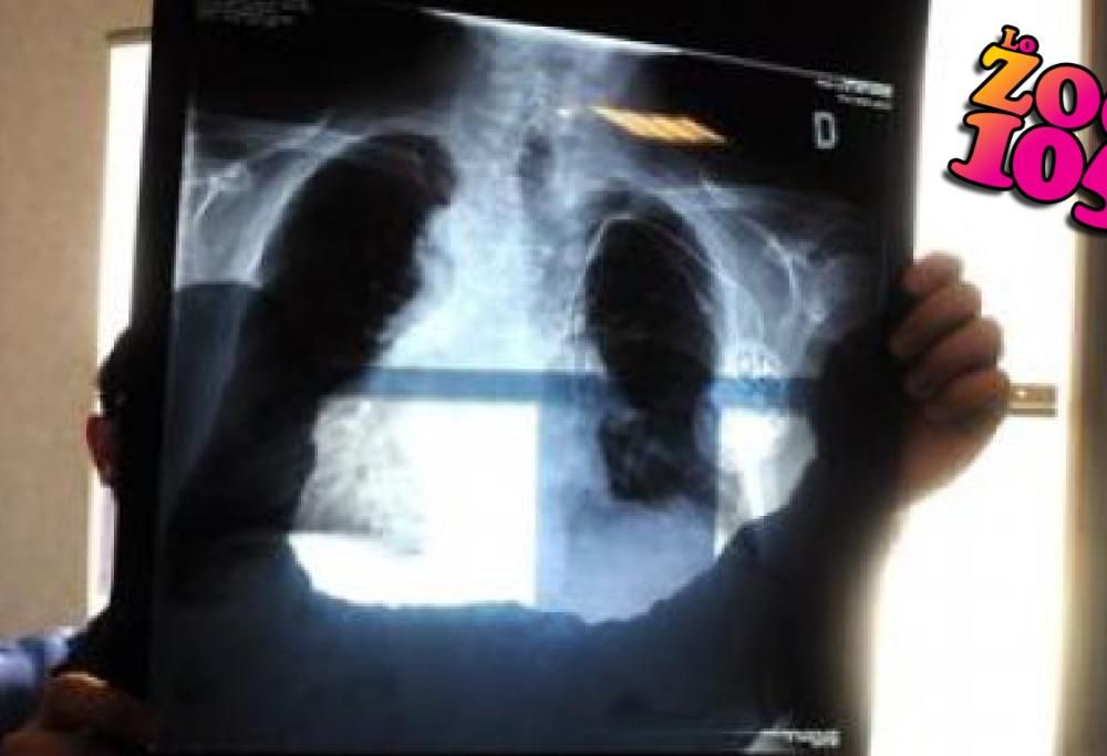 Annusa i propri calzini puzzolenti tutte le sere, ricoverato per infezione ai polmoni