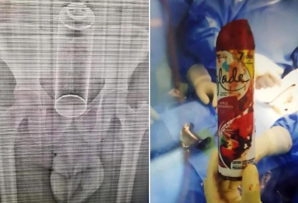 Gioco erotico finito male: ricoverato a causa di un deodorante incastrato!