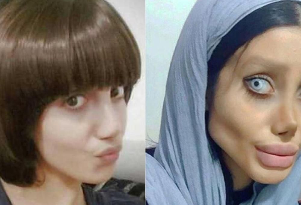 VOLEVA DIVENTARE ANGELINA JOLIE: 50 INTERVENTI IN 3 ANNI ED ECCO COM’E’ DIVENTATA