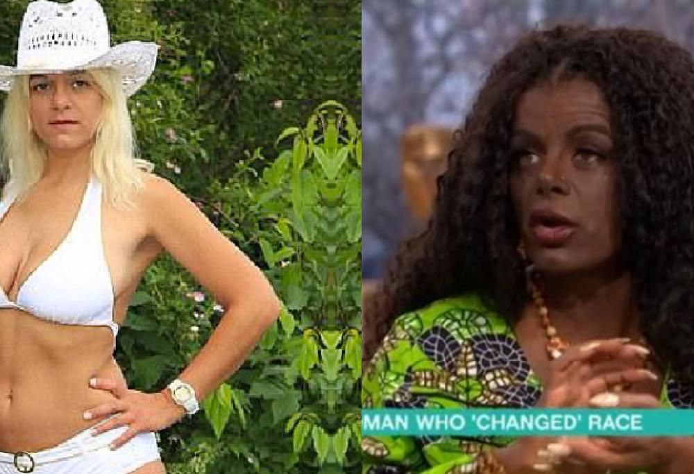 Donna bianca diventa nera grazie alle iniezioni di melanina