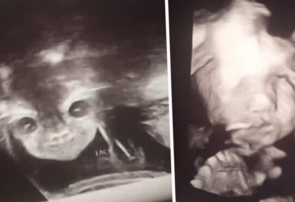 La terrificante ecografia del bambino che ha terrorizzato la madre!