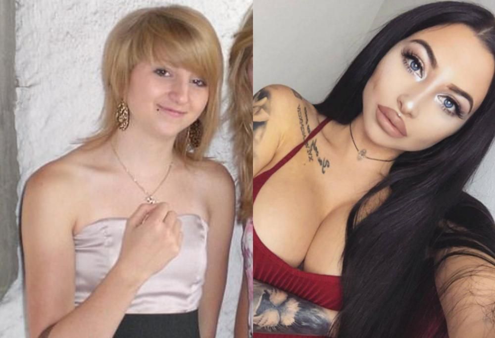 Ragazza vittima di bullismo spende 43mila euro in chirurgia plastica