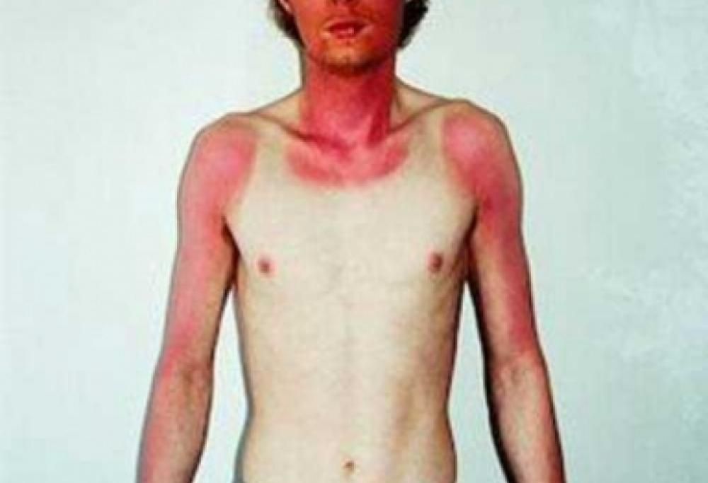 Come non prendere il sole, questa estate!