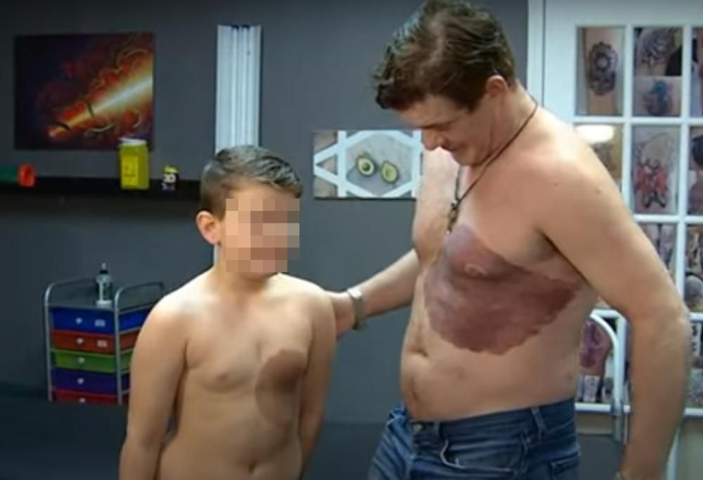 Questo papà si è fatto tatuare la stessa voglia di suo figlio per solidarietà