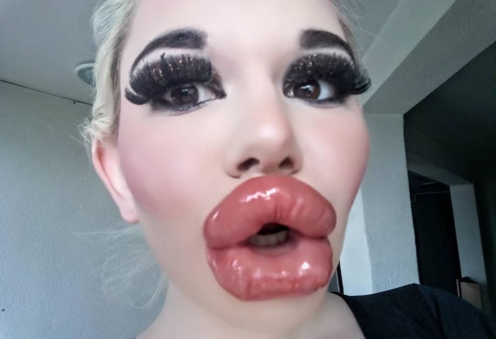 Aspira ad avere le labbra più grandi del mondo, donna si sottopone alla ventesima iniezione