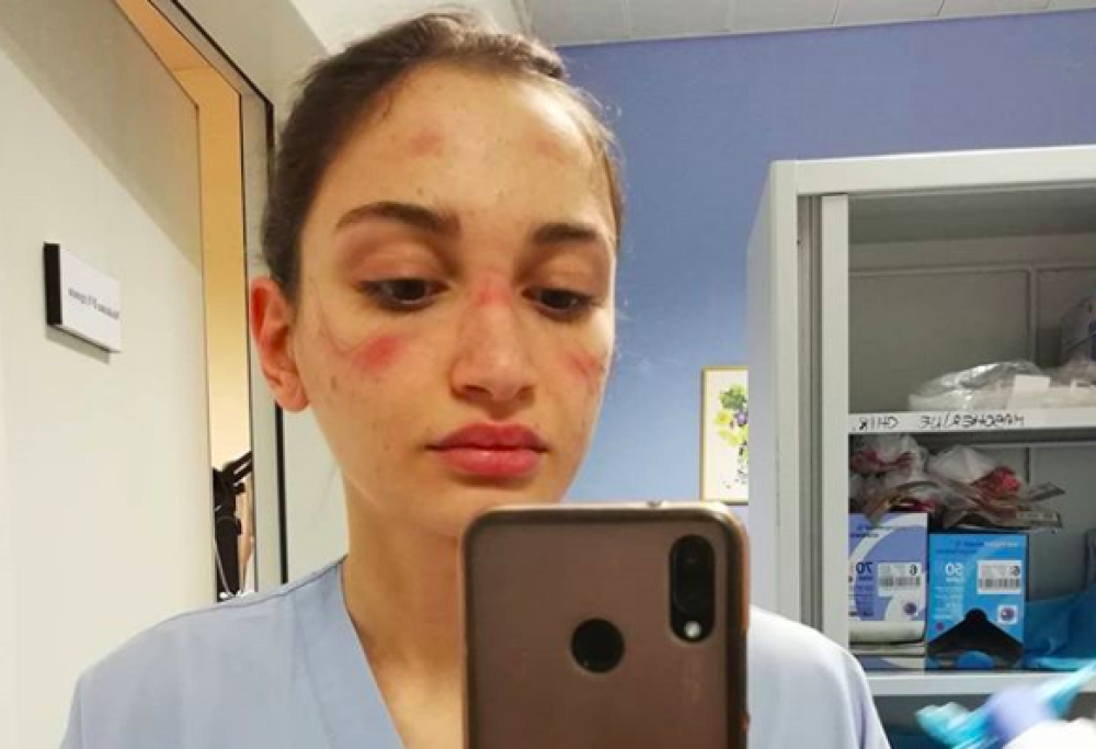 Infermiera con i lividi da mascherina: “Non vanificate i nostri sforzi, restate a casa”