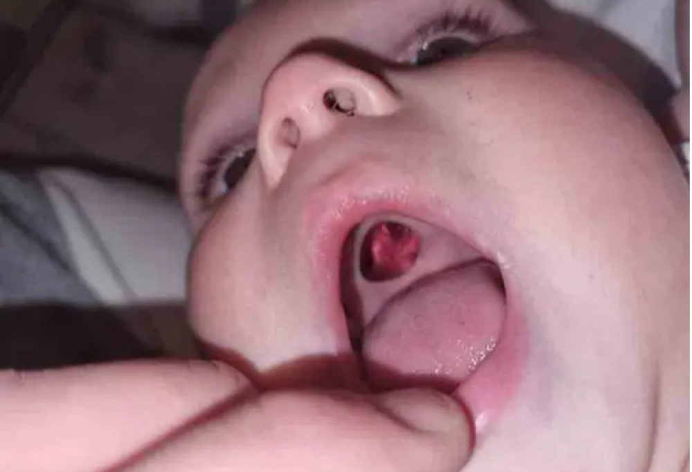 Aiuto, mio figlio ha un buco nel palato!