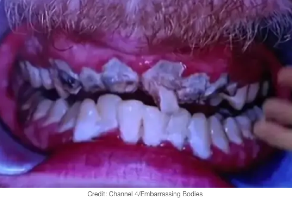 Non si lava i denti per 20 anni