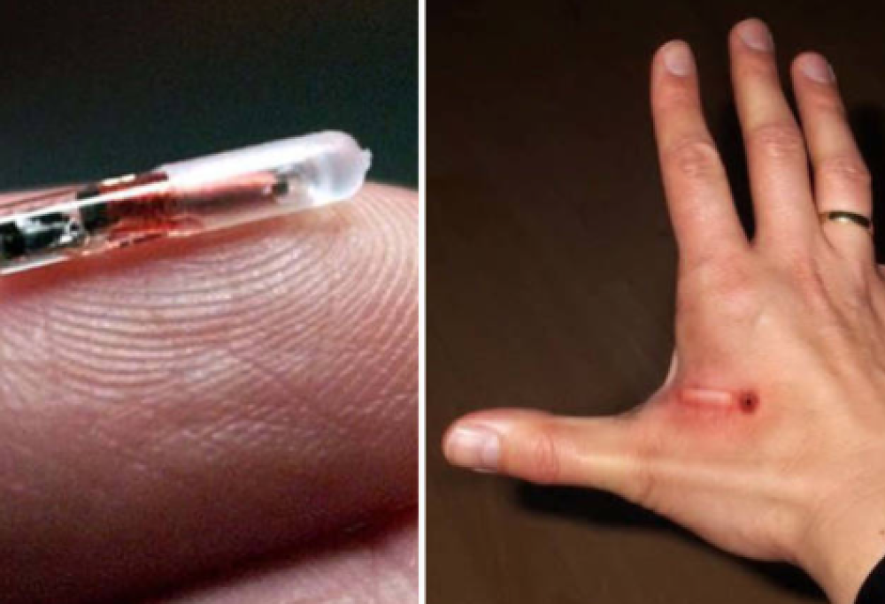 Microchip sotto pelle in arrivo per tutti?