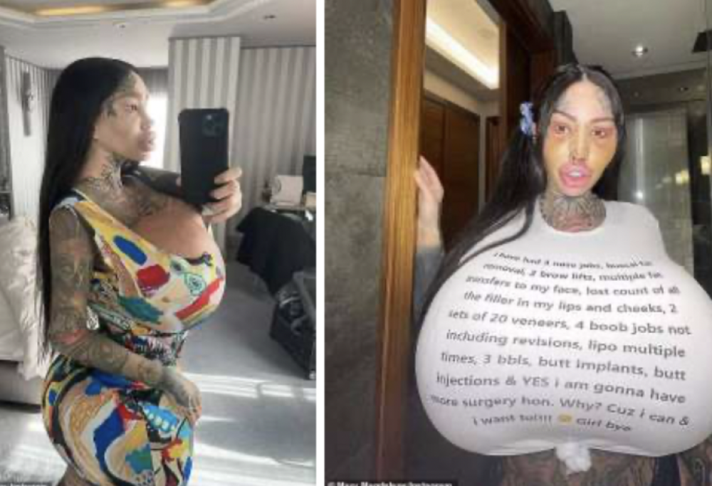 Intervento per avere una vagina “grassa”