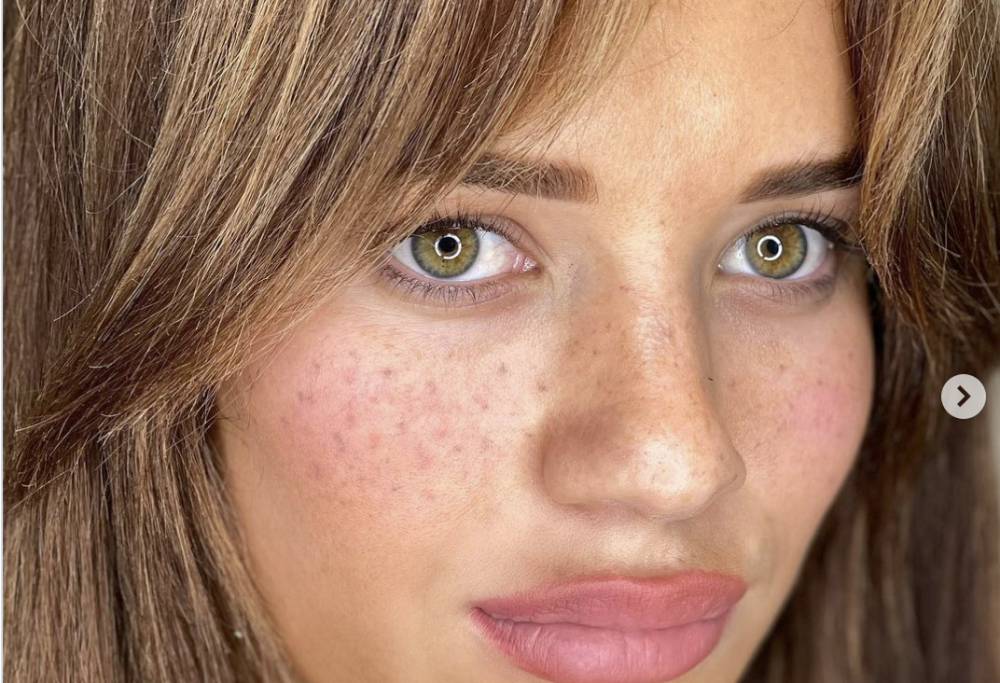 Si tatua le lentiggini e finisce in ospedale