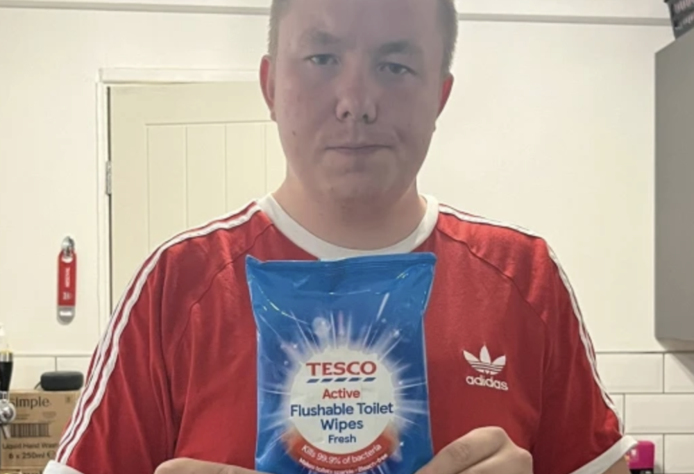 Sedere ustionato con le salviette antibatteriche