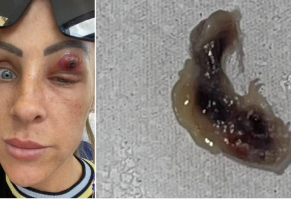 Viscido parassita in una palpebra