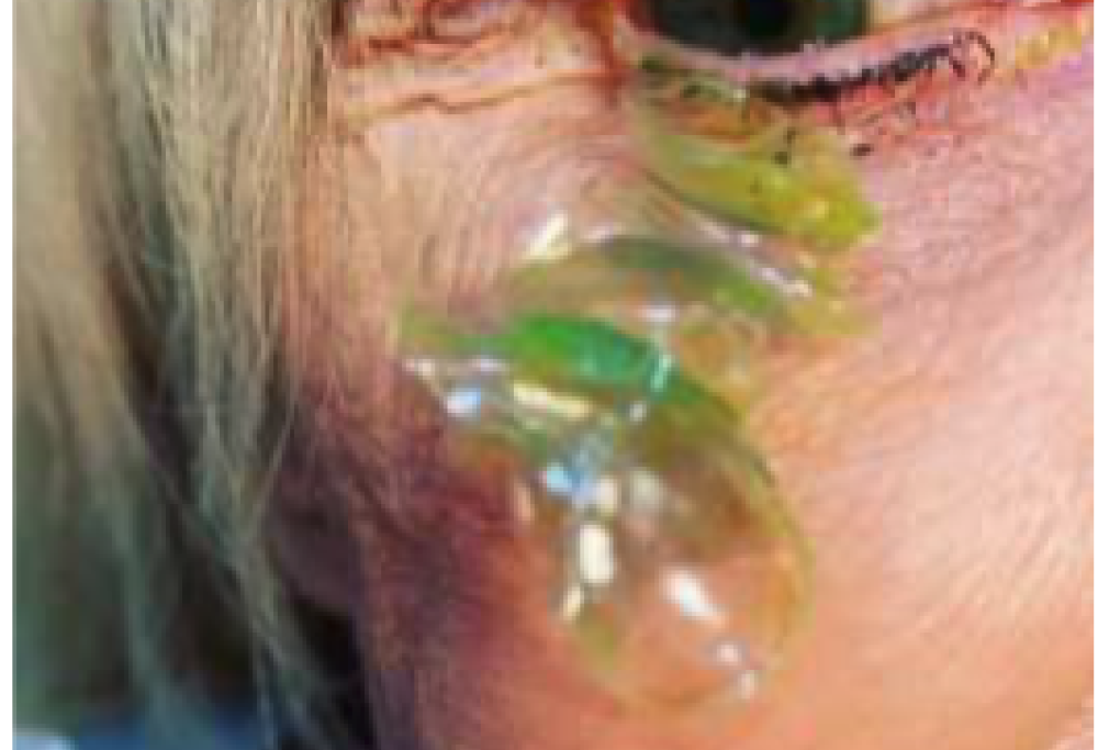 Le estraggono 23 lenti a contatto