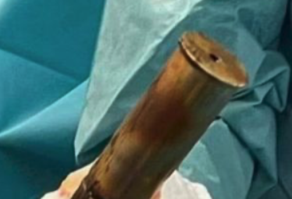 Ultraottantenne con bomba nel retto