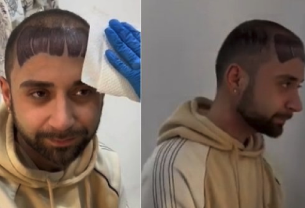 Frangetta tatuata contro la calvizie