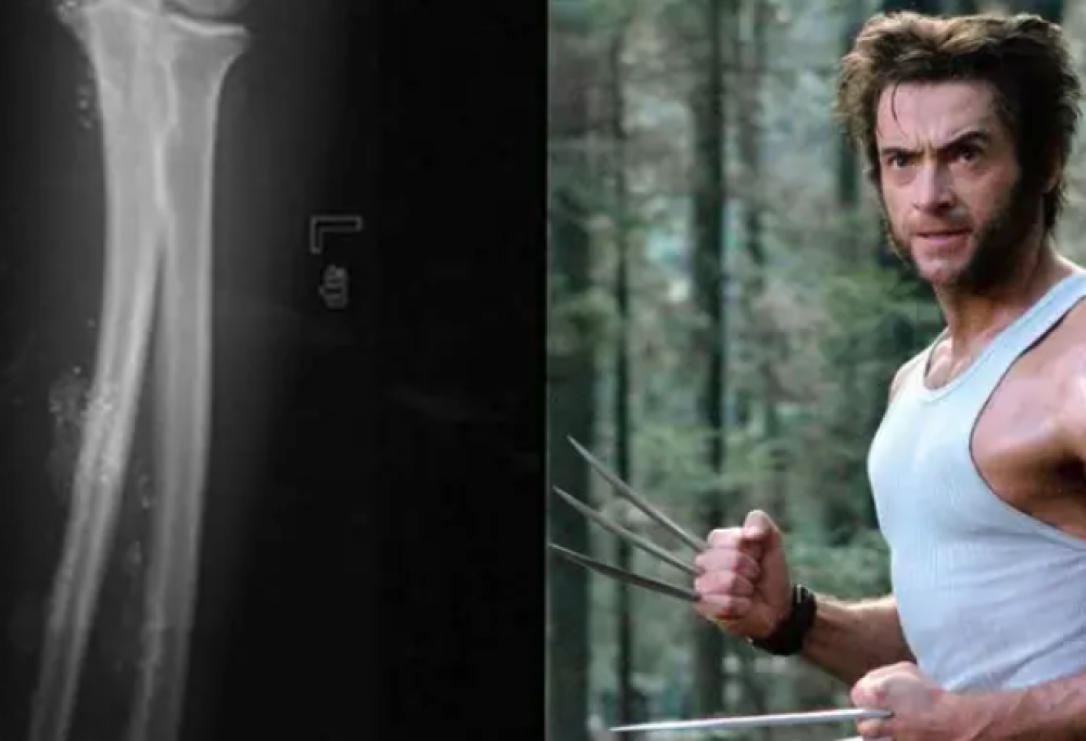 Si inietta mercurio per diventare un XMen