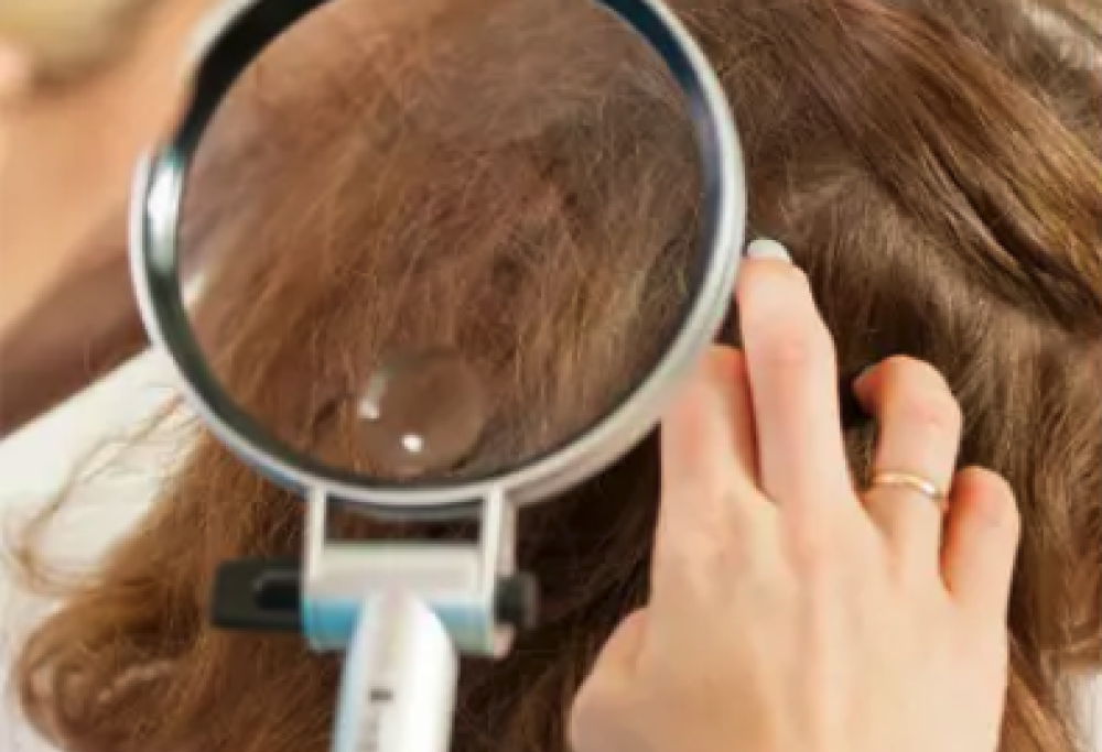 Rifiuta di eliminare i pidocchi del figlio perché vegana