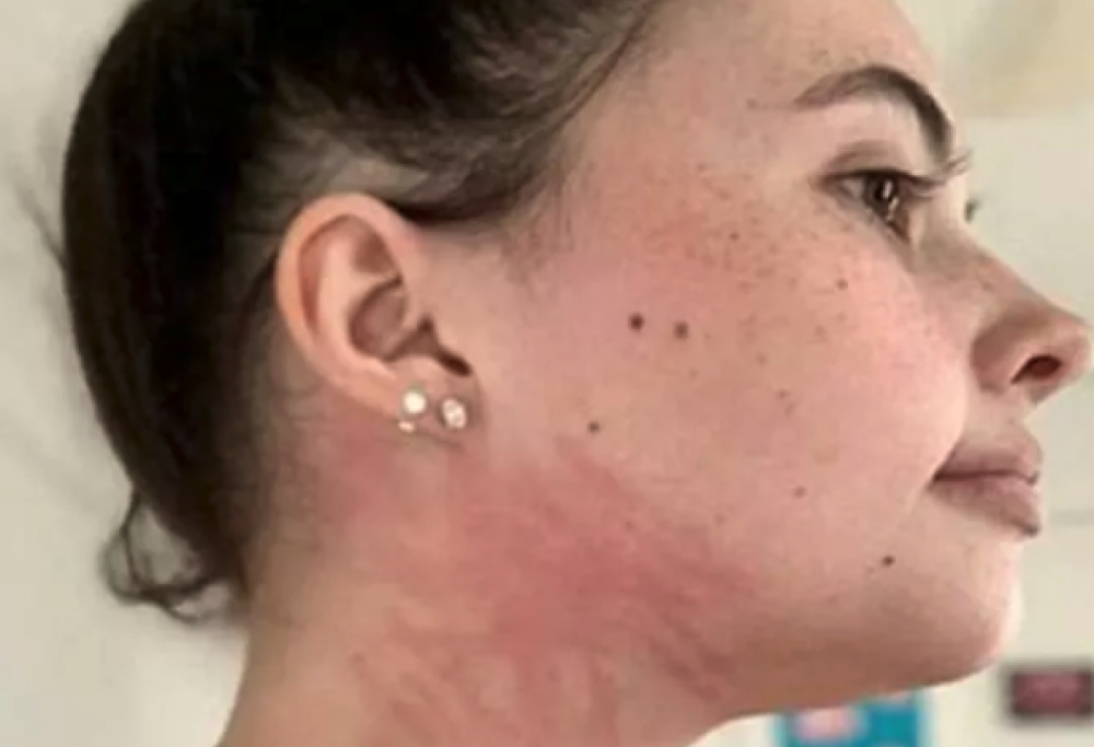 Allergica all’acqua, non può farsi la doccia e bere