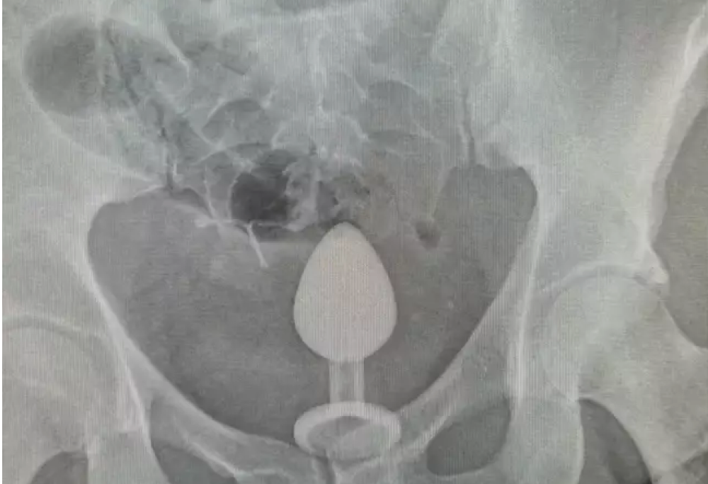 Il sextoy non esce più, donna al pronto soccorso