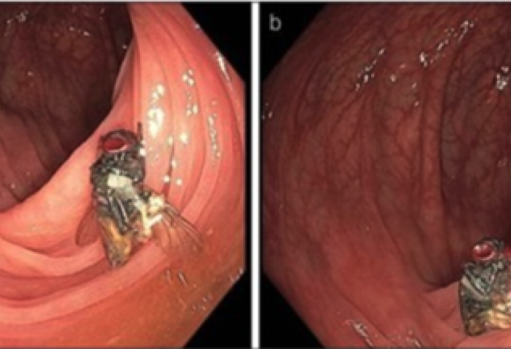 Scopre di avere una mosca nell’intestino