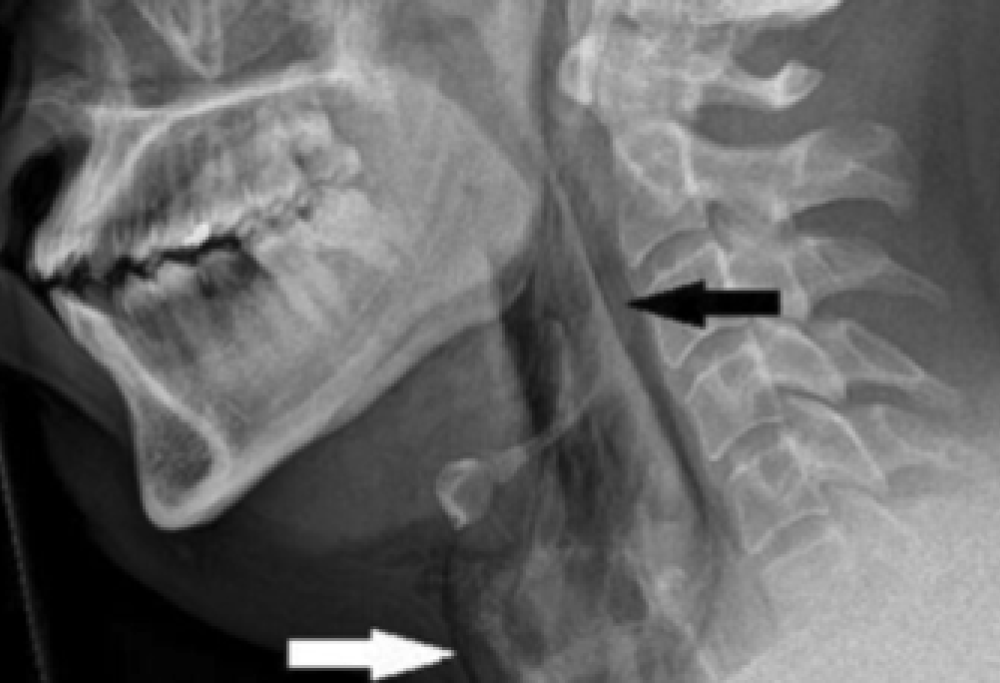 Trattiene uno starnuto e si lacera la trachea