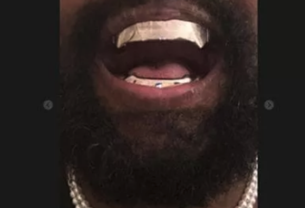 Kanye West, protesi in titanio da oltre 850mila dollari