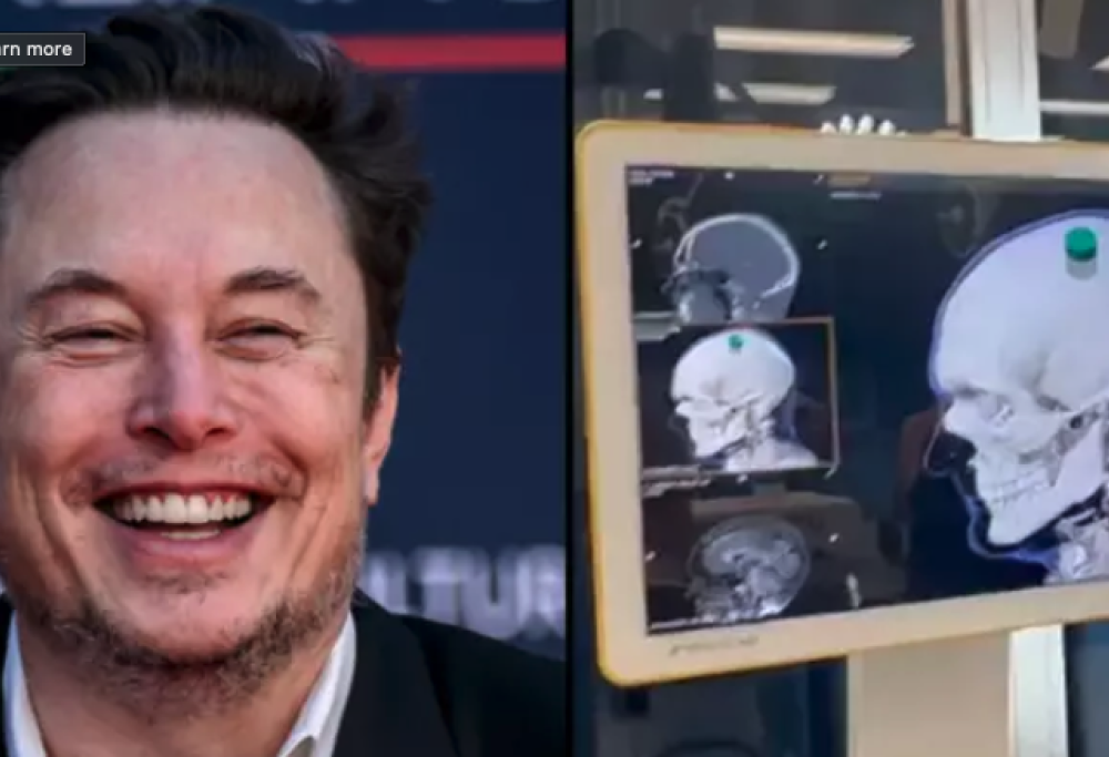 Impiantato su cervello umano il primo chip di Musk