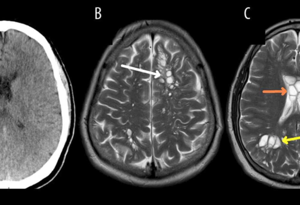 Mangia pancetta poco cotta, vermi nel cervello