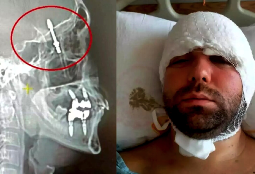 Dentista spinge troppo e la vite finisce nel cranio