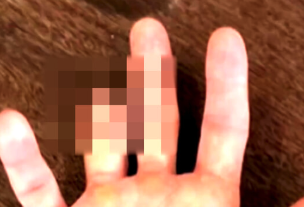 Si fa amputare un dito per partecipare alle Olimpiadi