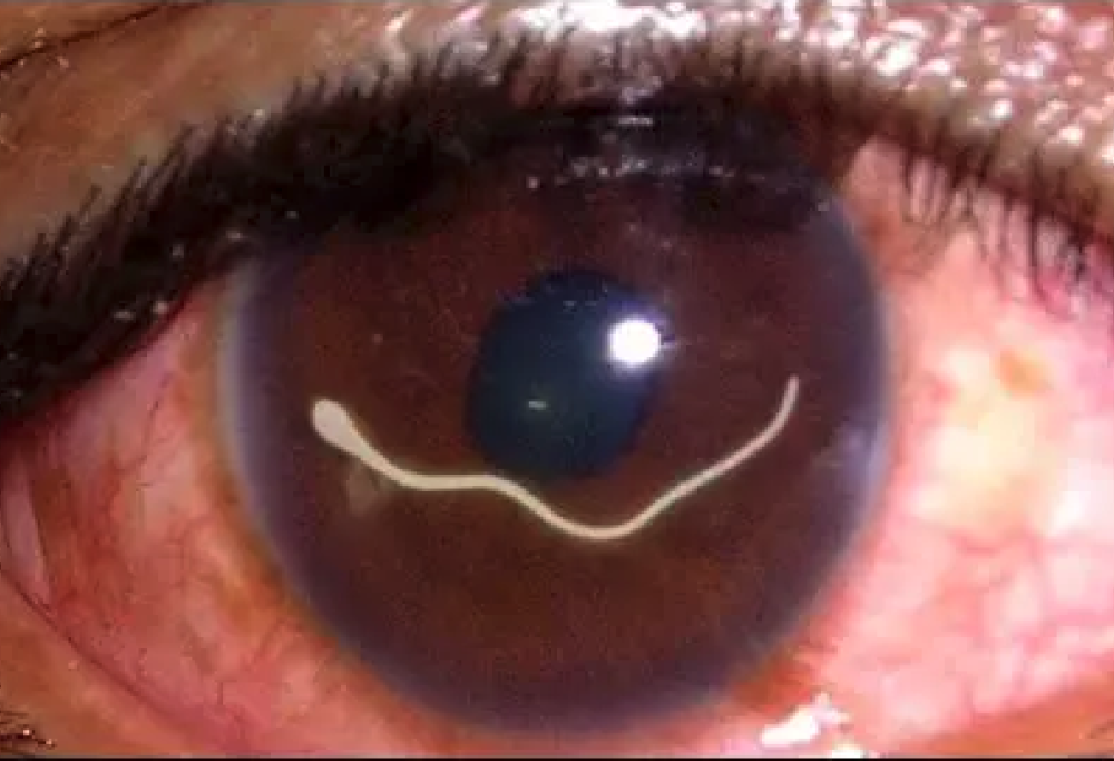 Pensava fosse congiuntivite ma era un verme