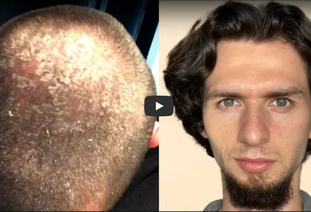 Per 8 anni non usa lo shampoo e la forfora sparisce