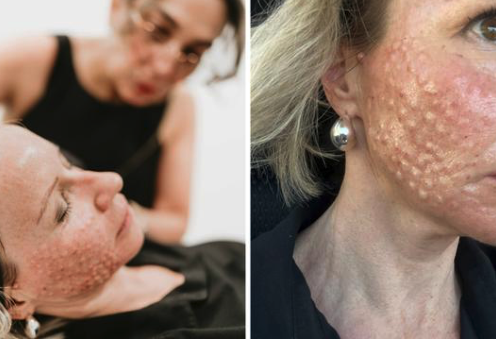 Salmon sperm facial, nuovo trattamento di bellezza